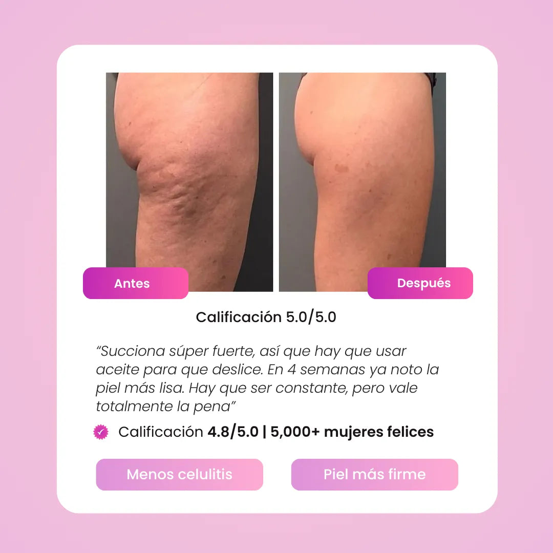 Terapia de Ventosas - Elimina la celulítis en 2 semanas