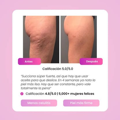 Terapia de Ventosas - Elimina la celulítis en 2 semanas