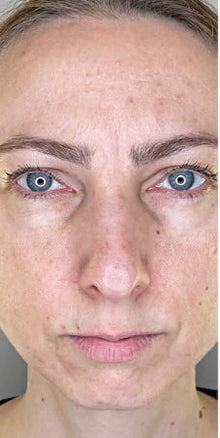 Before - Esta mascarilla salvó mi piel